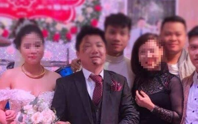 Chú rể nhọ nhem nhất năm: Ngã bầm tím mặt mày ngay trước ngày cưới