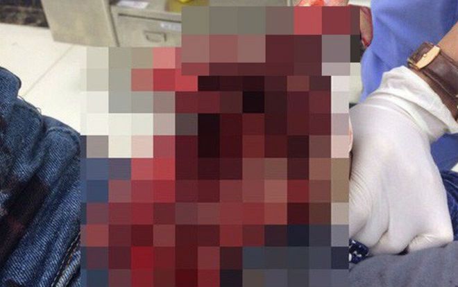 Ném quả pháo ra đường mãi không thấy nổ, nam thanh niên cầm lên kiểm tra bị nổ dập nát bàn tay