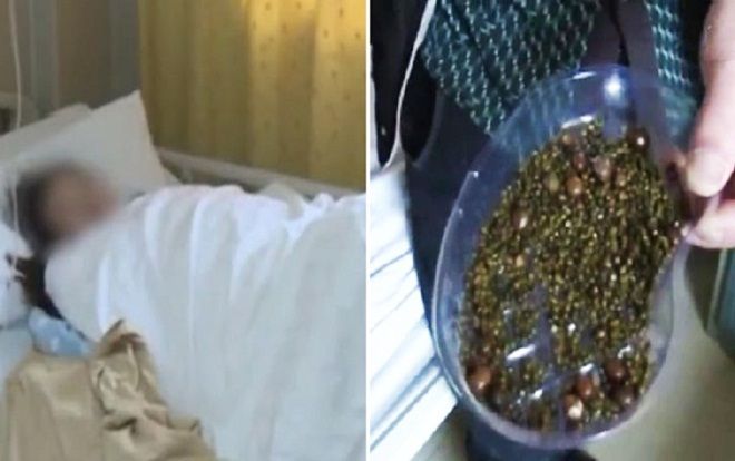 Nữ bệnh nhân có 2.000 viên sỏi mật vì nguyên nhân mà nhiều người vẫn thường chủ quan mắc phải