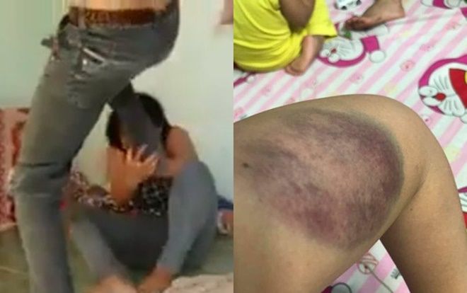 Xót xa cô vợ phải nhận trận đòn bầm tím cả người từ ông chồng vũ phu ngay ngày Valentine