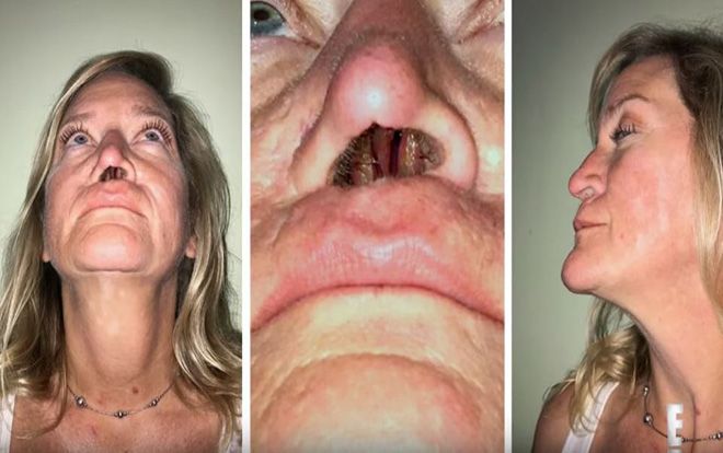 Xót xa người phụ nữ 11 năm sống với một lỗ mũi