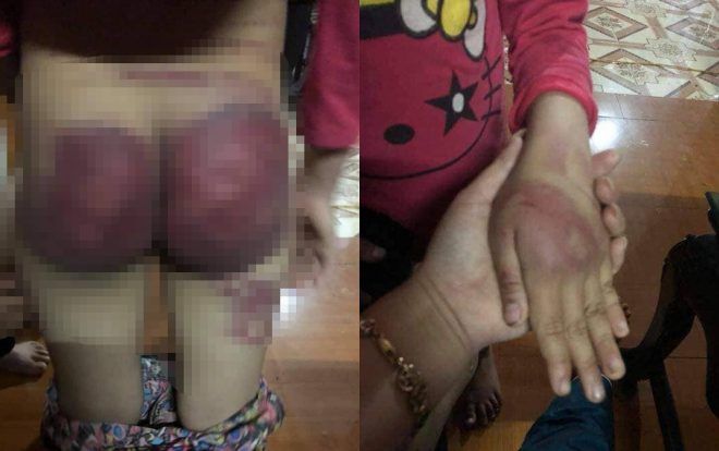 Nghi vấn học kém hơn anh trai, bé gái 8 tuổi bị bố đánh bầm tím mông