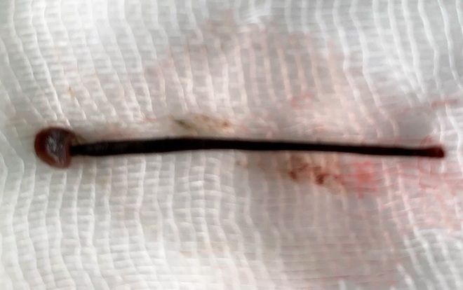 Rửa mặt ở khe suối, nữ sinh 21 tuổi bị con đỉa dài 4 cm chui vào mũi