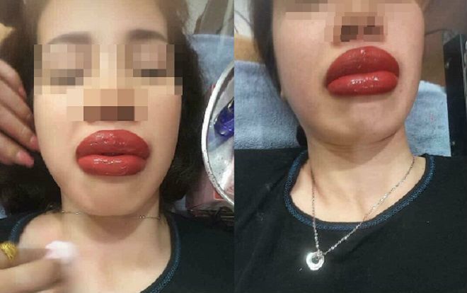 Cô gái đau đớn phải nhận kết đắng khi đi xăm môi làm đẹp, đôi môi sưng tều như 2 cây xúc xích