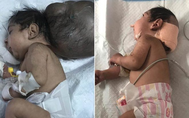 Giải cứu bé sơ sinh '2 đầu' sau khi bị chính cha ruột chôn sống