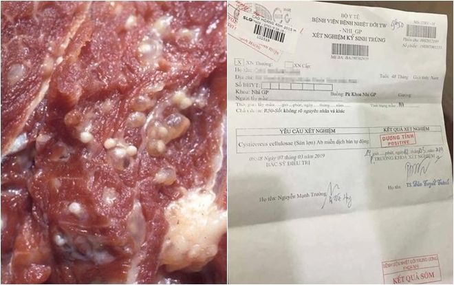 Sau khi ăn thịt bẩn, gà thối, số lượng học sinh dương tính với sán tiếp tục tăng cao khiến nhiều người lo lắng