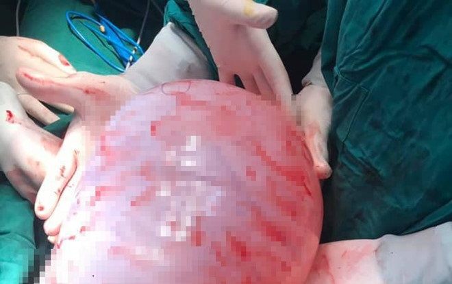Cô gái suýt mất mạng vì 'đốt ngải' chữa u nang buồng trứng