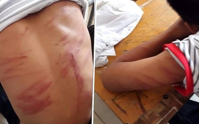 Nam sinh ngất xỉu ở lớp vì bị bố ruột bạo hành dã man