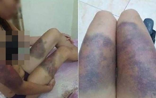 Thông tin mới nhất về sức khỏe cô gái bị nhóm đòi nợ 'bắt cóc', tra tấn dã man đến sẩy thai