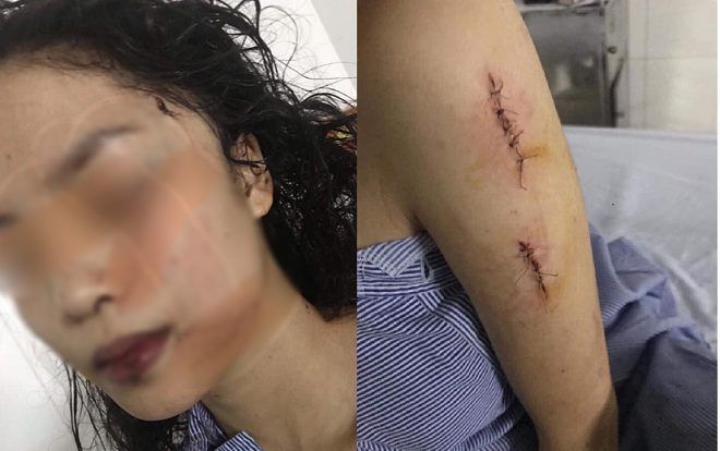 Đang ngồi chơi, thiếu nữ 18 tuổi bất ngờ bị nhóm bạn cũ xông vào rạch mặt, khâu 60 mũi