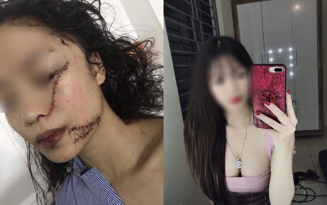 Thiếu nữ xinh đẹp bị rạch mặt, cổ và tay, phải khâu 60 mũi vì giành nhau… cái tủ lạnh