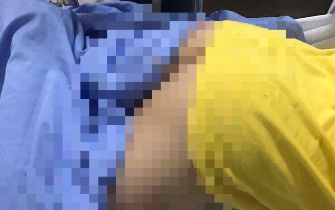 Bé trai lớp 4 bị bạn nghịch dại lấy bút chì đâm xuyên thủng mông 16 cm