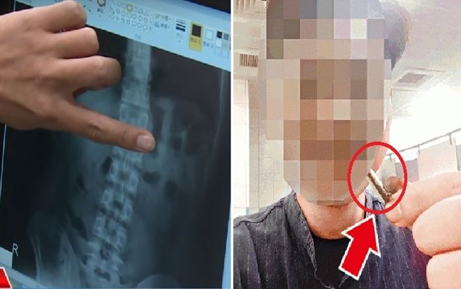 Vô tình nuốt tai nghe trong lúc ngủ nhưng phản ứng sau đó của thanh niên này mới ngạc nhiên