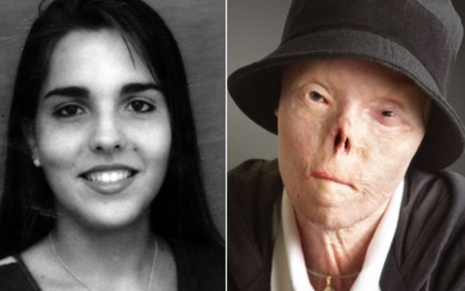 Cuộc đời của cô gái Venezuela bị biến dạng mặt vì tài xế say rượu