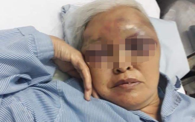 Đòi thăm con lúc rạng sáng, chàng rể hành hung mẹ vợ cũ bầm tím mặt