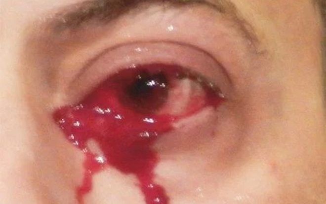 Đang bình thường, người đàn ông hoảng hốt thấy mình khóc ra máu