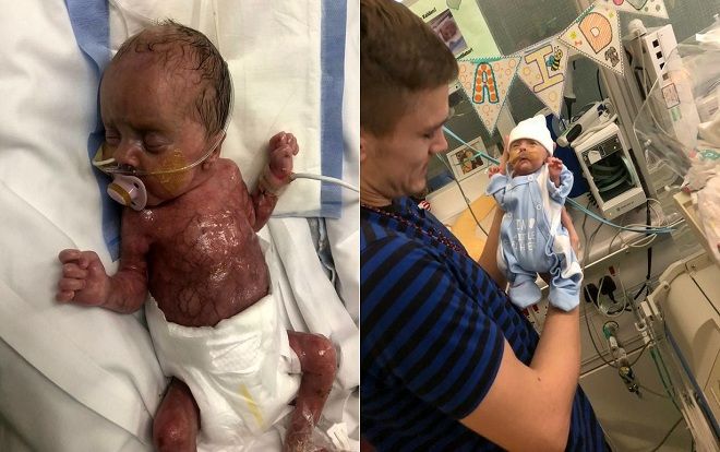 Sinh ra không có da, em bé sống sót thần kỳ