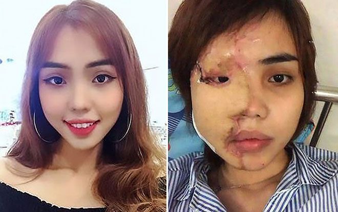 Vụ cô gái bị chồng sắp cưới tạt axit gây rúng động báo Tây: 'Hung thủ đáng bị án chung thân, tử hình'