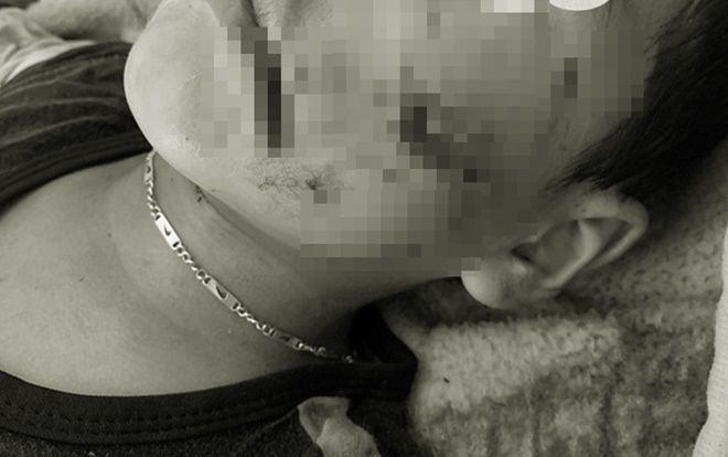 Bé trai 5 tuổi ở Sơn La bị chó nhà nuôi cắn nát mặt: Chó chưa được tiêm phòng dại