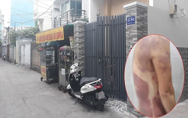 Mâu thuẫn chỗ đỗ xe, người phụ nữ bị hàng xóm tạt cả chảo dầu sôi gây bỏng nặng