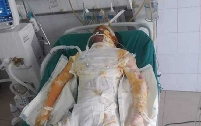 Sụt lò luyện gang tại Hải Dương, nhiều công nhân bị bỏng nặng