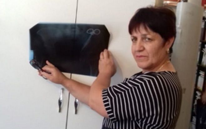 Người phụ nữ ngã ngửa khi phát hiện kẹp phẫu thuật bị bỏ quên 23 năm trong bụng