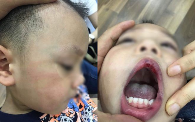 Buộc thôi việc nữ giáo viên trường mầm non Ecokids đánh học sinh nhưng nói dối là bé tự ngã