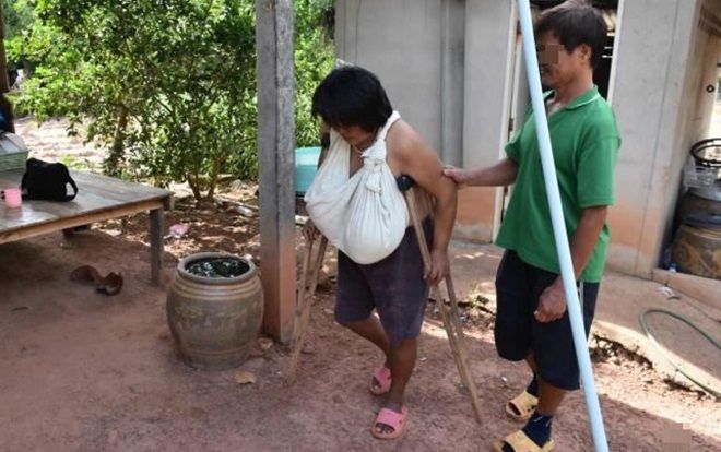 Bệnh lạ khiến người phụ 46 tuổi có bộ ngực phát triển không ngừng suốt 9 tháng, phải dùng nạng để di chuyển