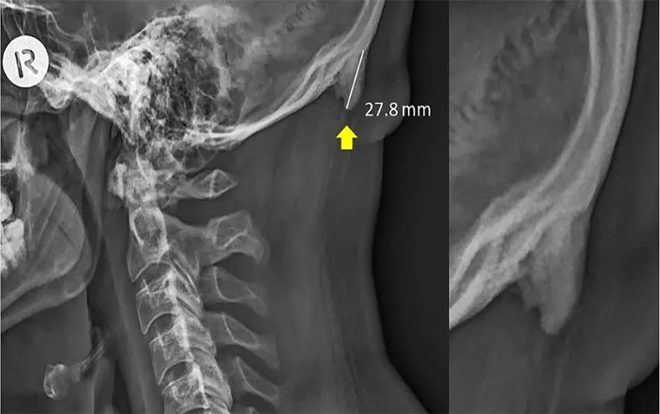 Sốc với phát hiện mới: Người trẻ mọc sừng vì dùng smartphone quá nhiều