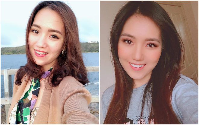 Muốn trở thành cô dâu đẹp nhất, cô gái trẻ 'chịu khổ ' để niềng răng và cái kết bất ngờ