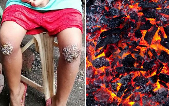 Quên mang cặp sách về nhà, bé gái 8 tuổi bị mẹ phạt quỳ trên than hồng