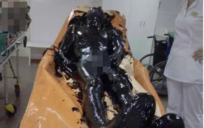 Ngạt thở khi rơi vào hố nhựa đường đặc quánh, người đàn ông may mắn sống sót