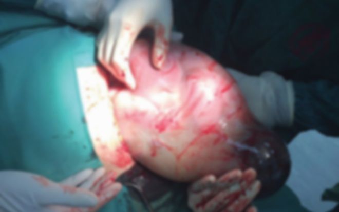 Hy hữu bé gái nặng hơn 3kg chào đời còn nguyên túi ối