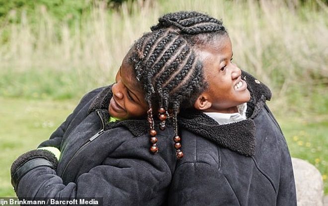 Nghị lực sống mạnh mẽ của cặp song sinh 18 tuổi bị dính liền phần đầu