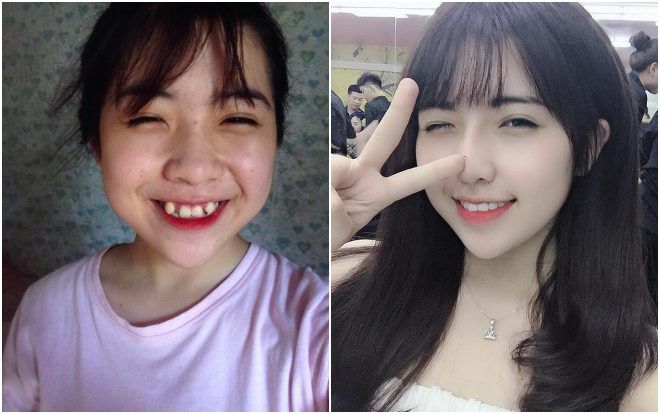 Vì crush, 9x quyết tâm giảm cân, làm răng để trở nên hoàn hảo và cái kết bất ngờ