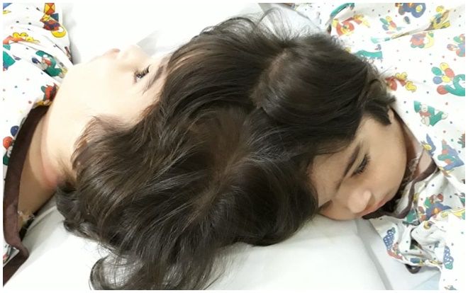 Cặp song sinh dính liền sọ được tách đôi an toàn sau 50 giờ phẫu thuật