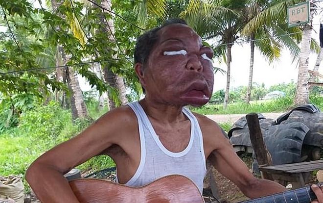 Mắc bệnh lạ, người đàn ông mang bộ mặt biến dạng, phình to gấp 3 lần bình thường