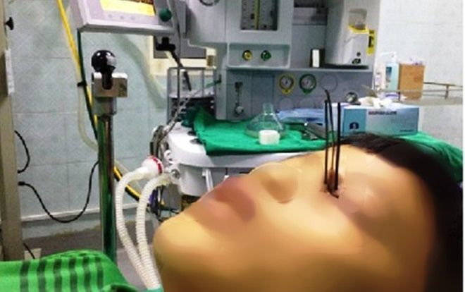 Nam sinh 13 tuổi bị 3 đinh kim loại găm xuyên vào mắt vì dùng súng tự chế 