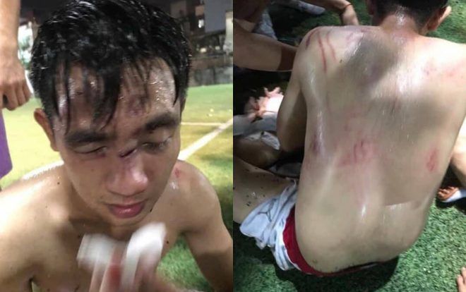 Mâu thuẫn trong lúc tranh chấp bóng, nam thanh niên bị đội bóng 'xăm trổ' đánh chấn thương