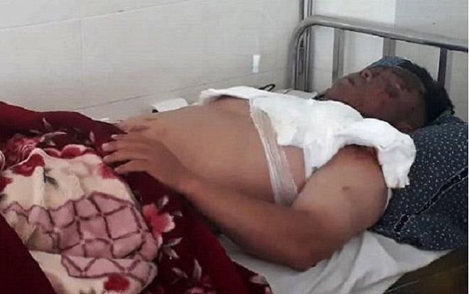 Hỏi tuổi của bố bạn nhậu, nam thanh niên bị hất nồi nước lẩu đang sôi vào mặt