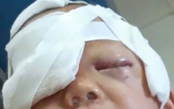 Bé trai 20 tháng tuổi bị chó nhà tấn công gãy xương mũi ở Thái Nguyên