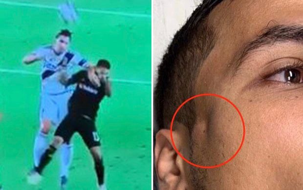 Rợn người cảnh xương sọ nứt toác của cầu thủ bị Ibrahimovic thúc cùi chỏ