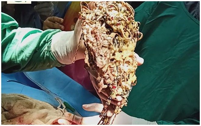 Cô gái suýt chết khi nuốt trọn số trang sức hơn 1,5 tỷ của gia đình vì bệnh lạ