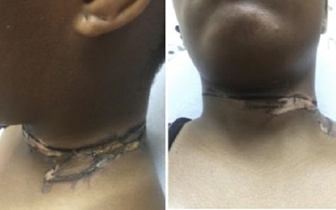 Thói quen sạc điện thoại trên giường khiến cô gái phải trả giá cực đắt