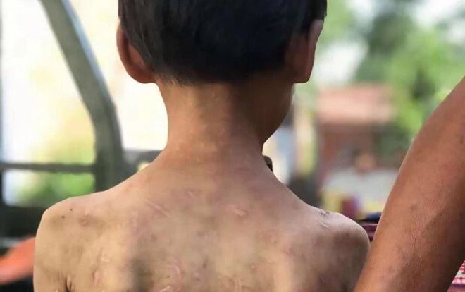 Xót xa cô bé 7 tuổi cơ thể chằng chịt vết thương vì bị bà đánh bằng dây cáp, dùng kìm bấm vào người