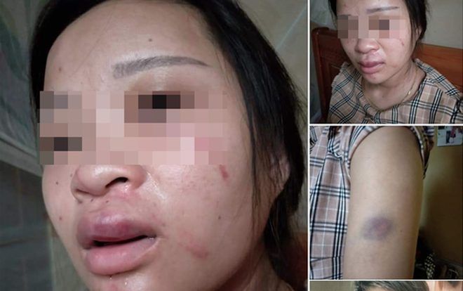 Vụ vợ tố bị chồng đánh bầm dập khi mua đôi giày 135 nghìn đồng: 'Không phải chỉ vì chuyện mua đôi giày'