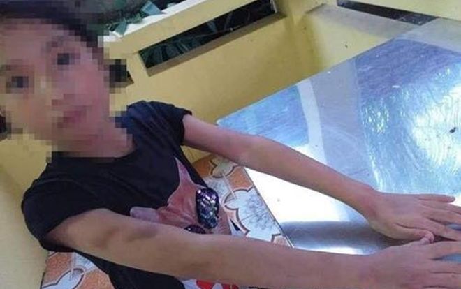 Bé gái 9 tuổi bị cô giáo dạy luyện đọc chữ cầm thước đánh vào má bầm tím