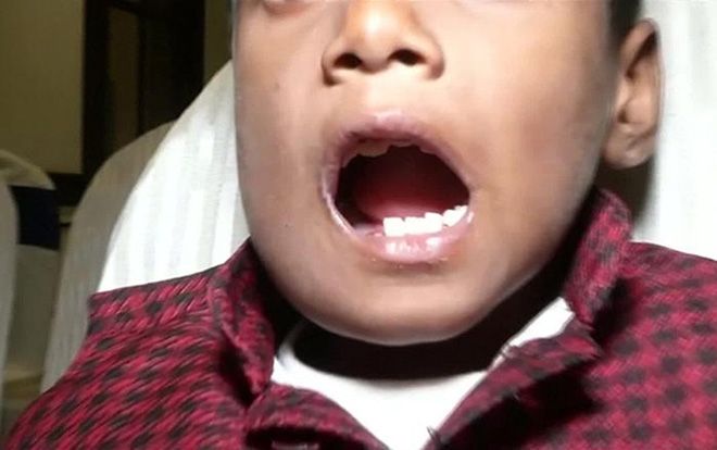 Mắc bệnh lạ, bé trai mọc đến 526 chiếc răng