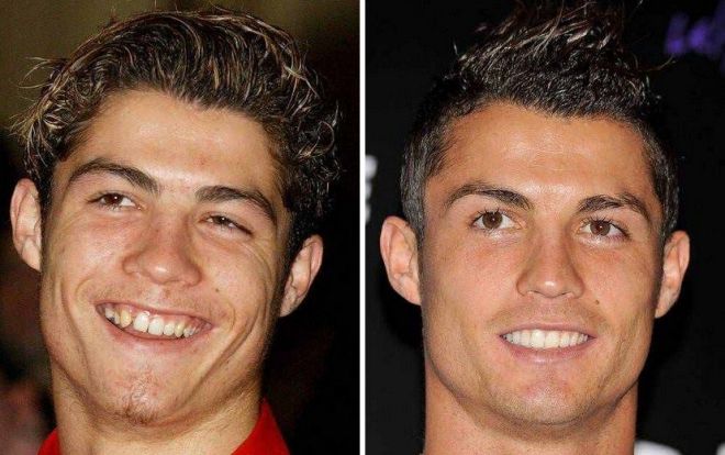 Chuyện Công Phượng muốn nâng mũi, kéo chân: Đến Ronaldo cũng nhờ dao kéo