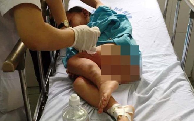 Học kỹ năng phòng chống cháy nổ bằng cồn, 3 trẻ mầm non bị bỏng nặng